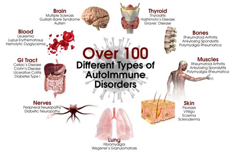 Functional Medicine Approach to Autoimmune Disease | UltraWellness