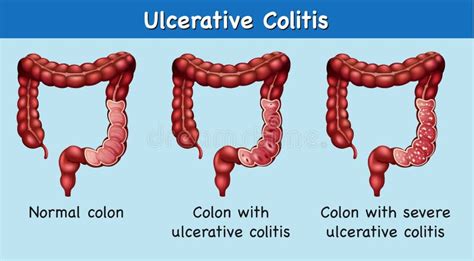 Ulcerative colitis stock vector. Illustration of ulcerative - 23685404