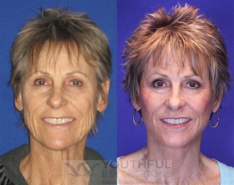 CO2 Laser Skin Resurfacing Before & After Photos Patient 76 | Nashville, TN | Youthful Reflections