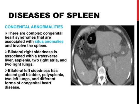 Diseases of spleen