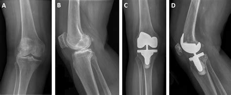 Varus-valgus constrained insert with posterior-stabilized femoral components in complex primary ...