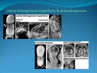 Skeletal dysplasia | PPT