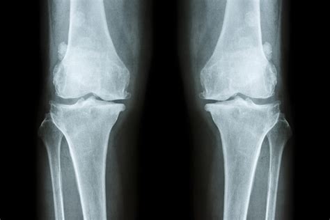 What You Should Know About Bone Spurs | Banner Health