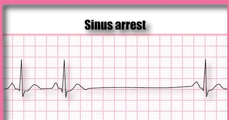 ECG Educator Blog : Sinus Arrest