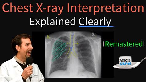 Beautiful How To Check X Ray Report Of Chest Write Incident