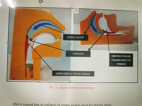 SURGERIES VS CPAP- TREATMENT OF OSA – Neurology & Sleep Centre