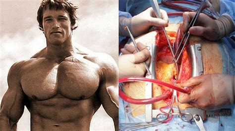 Arnold Schwarzenegger Heart Surgery 2024 - Raf Leilah