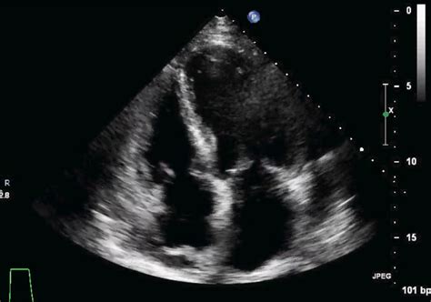 Practice TransTHORACIC Echo Basic Views