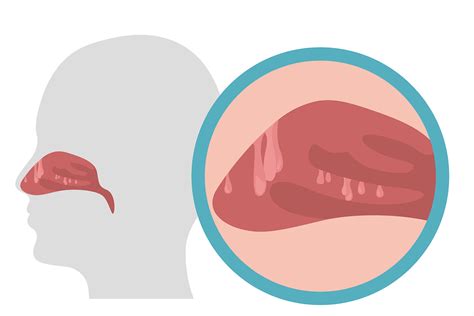 How to Manage Common Nasal Polyps Symptoms - kienitvc.ac.ke