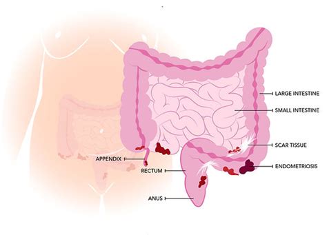 What is bowel Endometriosis | The Endo Foundation