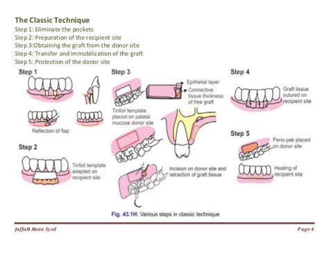 036. mucogingival surgery