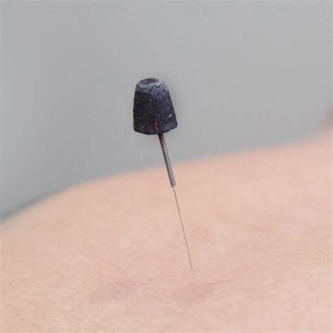 Moxibustion Therapy in Penrith - Evolution Medical Care