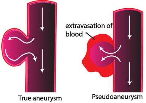 Pseudoaneurysm - Critical Care Sonography