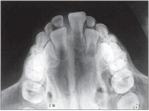 X-Ray Picture Guide - What to expect at the dentist...