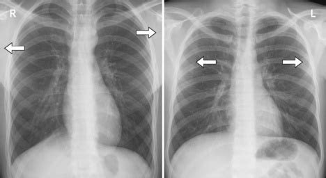 Technical factors in CXR interpretation | Radiology Key