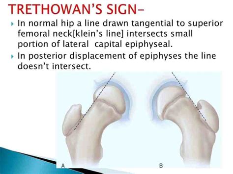 SLIPPED CAPITAL FEMORAL EPIPHYSIS (SCFE) - www.medicoapps.org