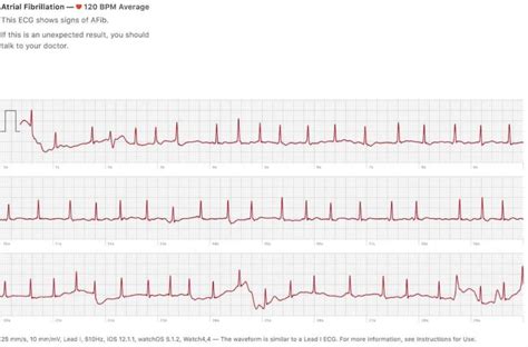 What Does A Normal Heartbeat Look Like On An Ecg | Webphotos.org