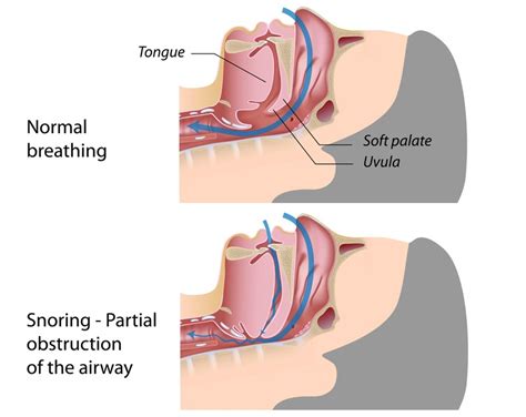 What Causes Snoring And What You Can Do About It - Life Health Max