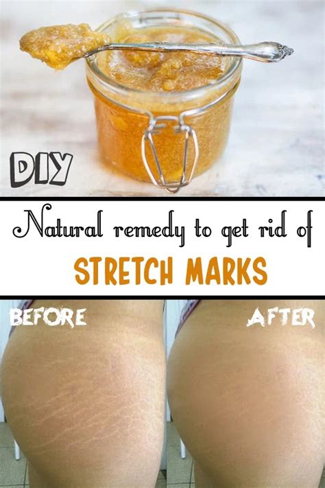 Top Notch Tips About How To Get Rid Of Stretch Marks On Stomach - Postmary11