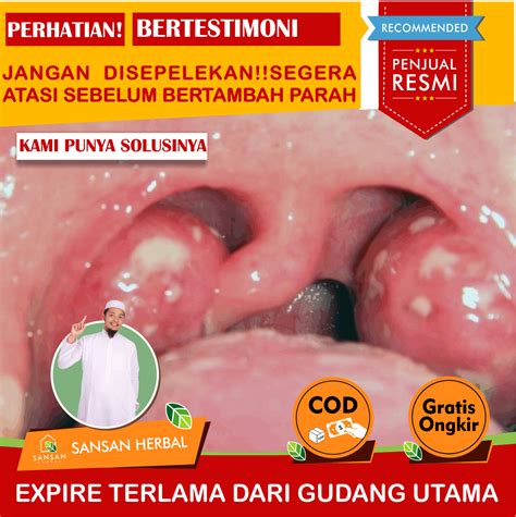 Herbal Radang Tenggorokan, Panas Dalam, Obat Amandel, Obat Amandel Anak ...