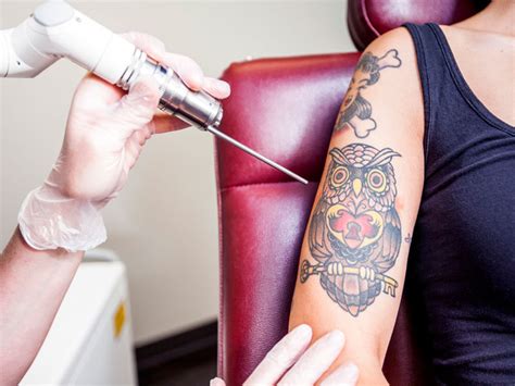 Tattoo Removal: The Modern Extraction of Ancient Art - Health Journal