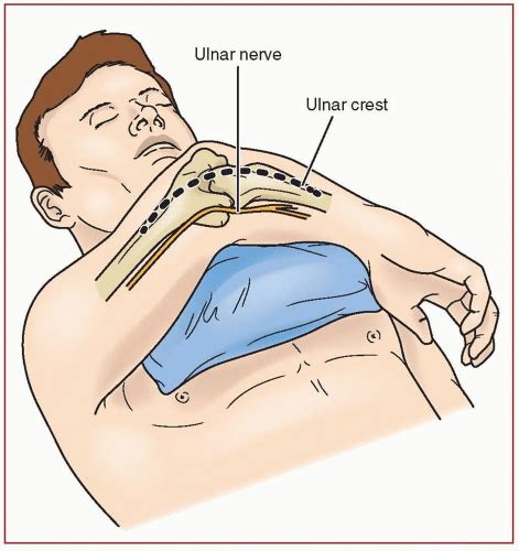 Total Elbow Arthroplasty | Musculoskeletal Key