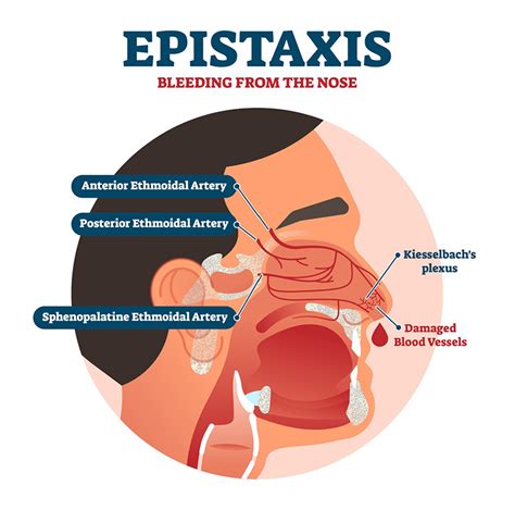 Nosebleed (Epistaxis) Tampa FL, Nasal & Sinus Services