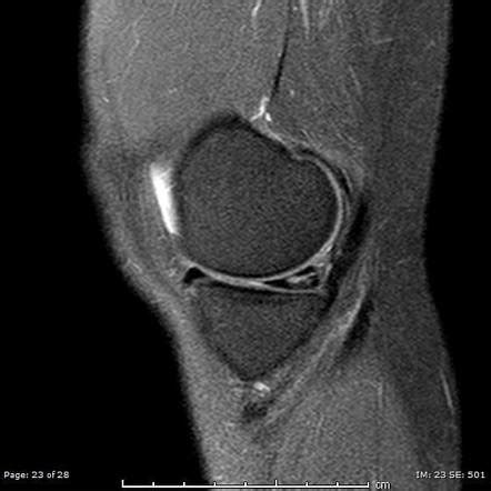 Medial Meniscus Tear Mri