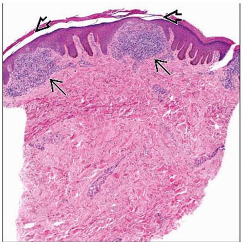 Similes & Metaphors in Pathology: Part 7 - Pathology Made Simple