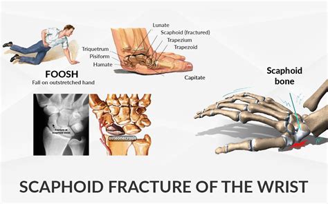 Scaphoid Fracture of the Wrist - Dr. Saurabh Aggarwal