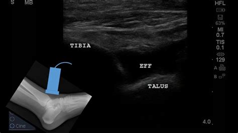 Ankle Effusion Emergency Department Point-of-care Ultrasound - YouTube