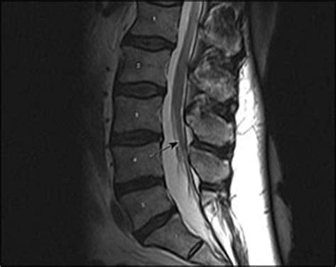 Spina Bifida Occulta Mri