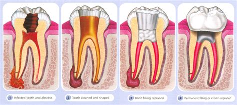 Root Canal Treatment | Specialist Endodontist | Chingford Mount Dental ...