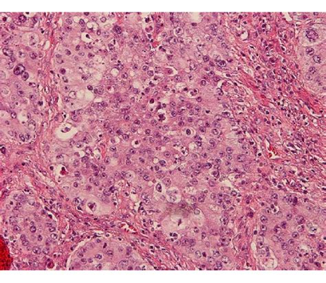 H&E staining of resected tumor tissue at 200x magnification. Histology... | Download Scientific ...