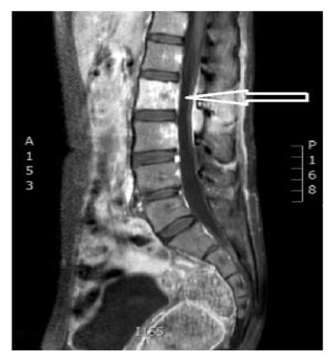 Mri Lumbar Spine Vertebrae