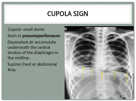 Cupola Sign X Ray - HOYOGG