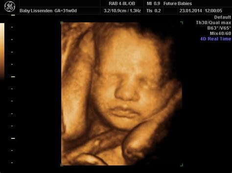 Pin on Ultrasound Scan Images