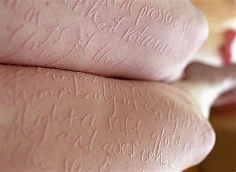 Skin Condition Dermatographia Made Into Art - Neatorama