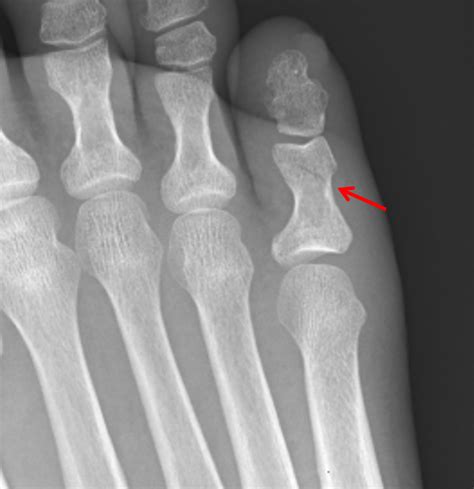 Splinting Proximal Phalanx Fracture