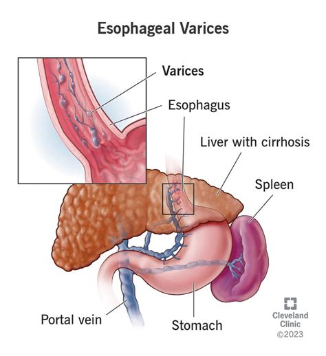 Esophageal Varices Anatomy