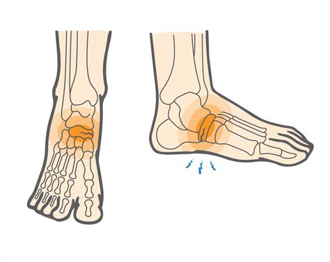 What is Navicular Stress Fracture & How to Heal Foot Injuries? - Upswing Health