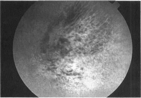 (a) Red-free photograph of choroidal melanoma 52 months following ...