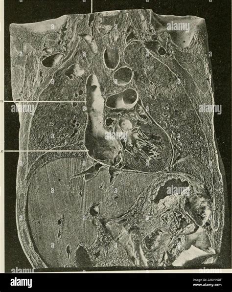 Phlebogram hi-res stock photography and images - Alamy