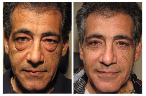 Dr. Soroudi Performs 1,500th Blepharoplasty in West L.A.