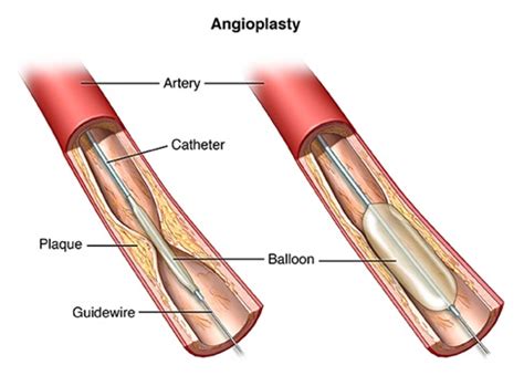 Angioplasty and Stent Placement for the Heart | Johns Hopkins Medicine