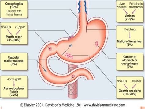 26 best "Hematemesis" images on Pinterest | Health, Medicine and Nurses