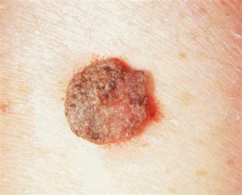 Seborrheic Keratosis Removal