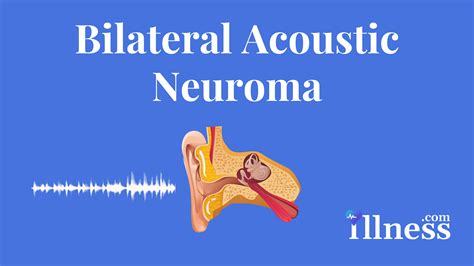 Bilateral Acoustic Neuroma : Overview, Causes, Symptoms, Treatment ...