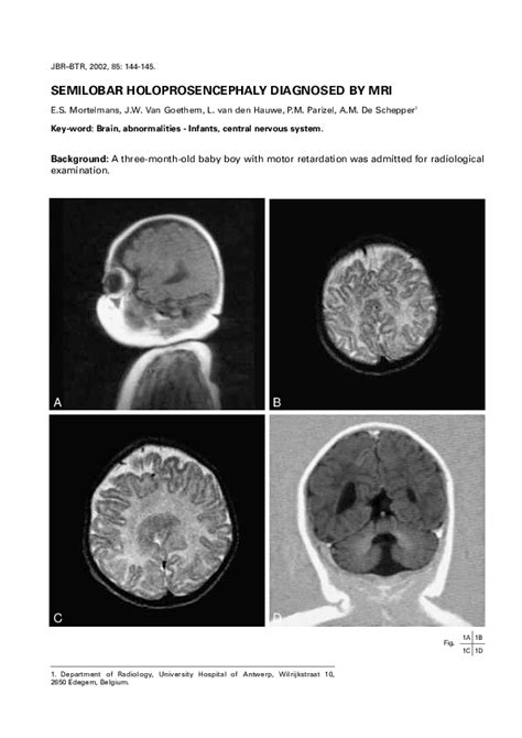 (PDF) Semilobar holoprosencephaly diagnosed by MRI | Johan Van Goethem ...