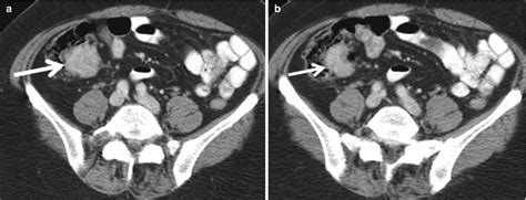 The Appendix | Radiology Key